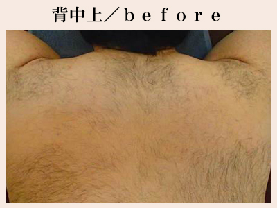 背中上の脱毛前
