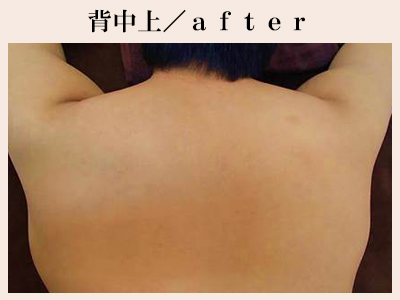 背中上の脱毛後
