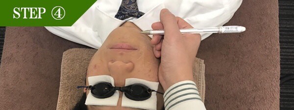 あごヒゲ脱毛Step4