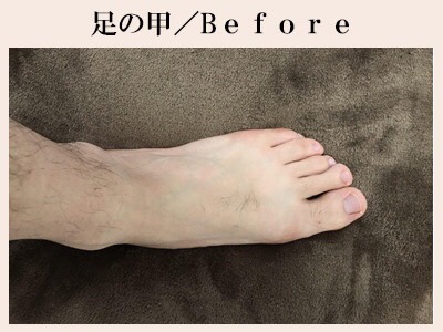 足の甲脱毛前