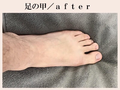 足の甲脱毛後