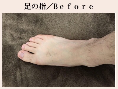 足の指脱毛前