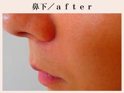 鼻下ヒゲ脱毛後