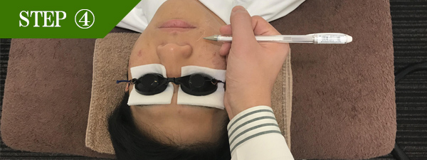 鼻下ヒゲ脱毛Step4