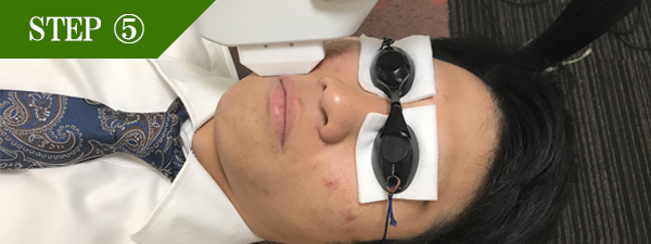 鼻下ヒゲ脱毛Step5