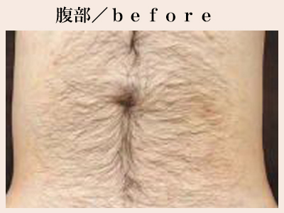 腹部の脱毛前