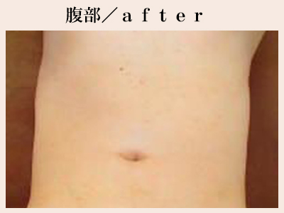 腹部の脱毛後