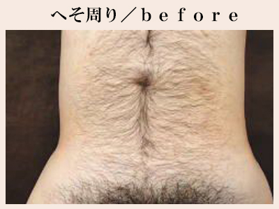 へそ周り脱毛前