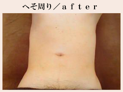 へそ周り脱毛後