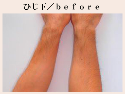 ひじ下の脱毛前