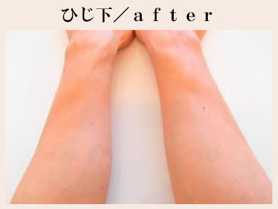 ひじ下の脱毛後