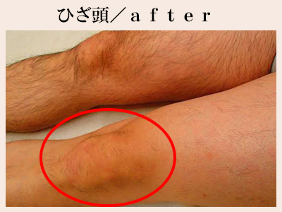 ひざ頭の脱毛後