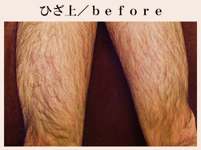 ひざ上の脱毛前
