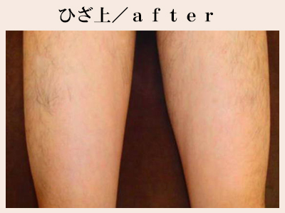 ひざ上の脱毛後