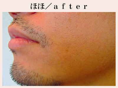 ほほ脱毛後