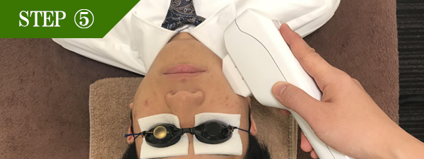 ほほ脱毛Step5