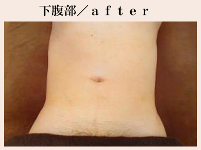 下腹部脱毛後