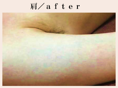 肩の脱毛前