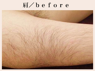 肩の脱毛後