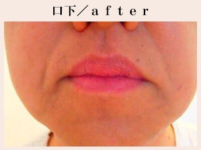 あごひげ脱毛After