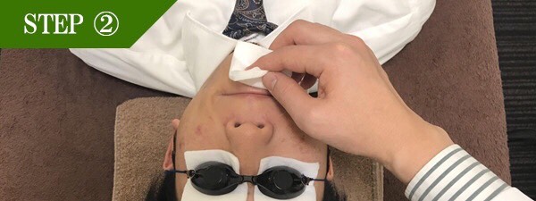 口下ヒゲ脱毛Step2