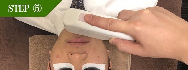 口下ヒゲ脱毛Step5