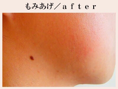 もみあげ脱毛後