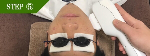 もみあげ脱毛Step5