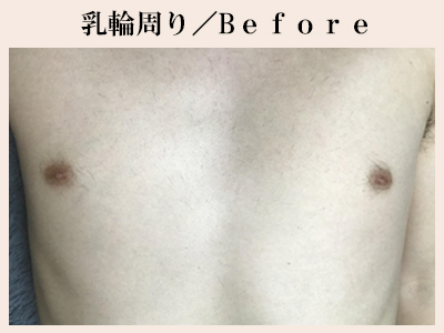 乳輪周り脱毛前