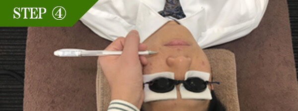 おでこ・眉間脱毛Step4
