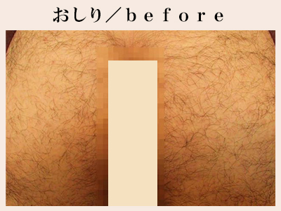 おしりの脱毛前