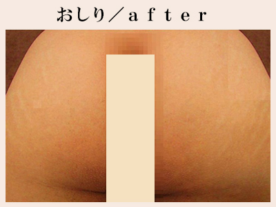 おしりの脱毛後