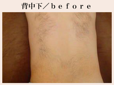 背中下の脱毛前