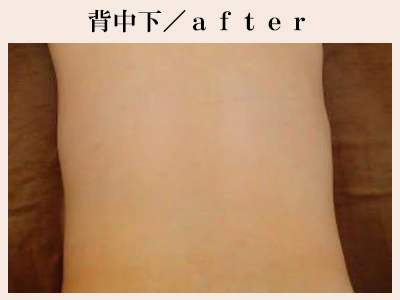 背中下の脱毛後