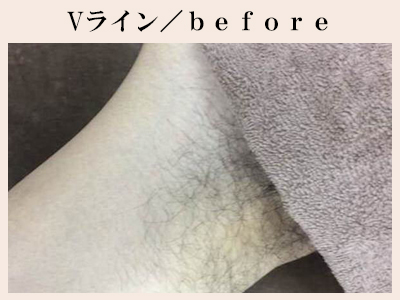 Vラインの脱毛前