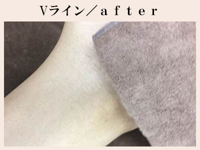 Vラインの脱毛後