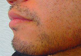 アゴ、ほほ、もみあげのデザインヒゲ脱毛の効果before