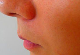 鼻下のヒゲ脱毛効果after