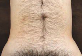 お腹周りの脱毛効果before