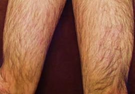 ひざ上（太もも）の脱毛効果before