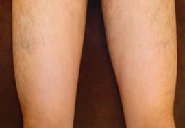 ひざ上（太もも）の脱毛効果after