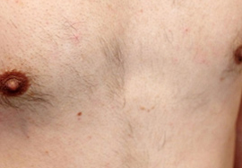 胸、乳輪周りの脱毛効果after