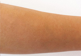 ひじ下の脱毛効果after